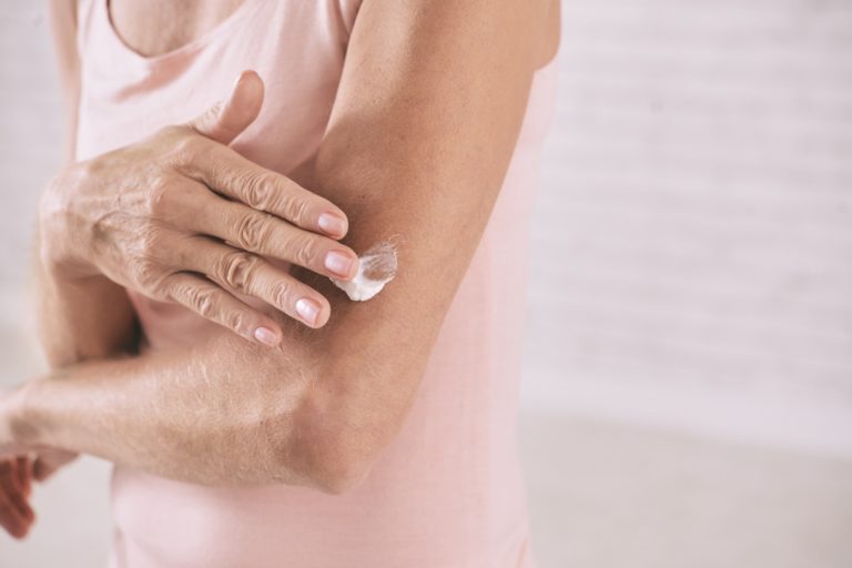 Donna anziana applica una crema sulla pelle secca del braccio